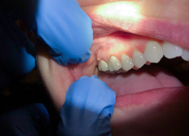 Best Emergency Dental Extractions in Mccamey, TX