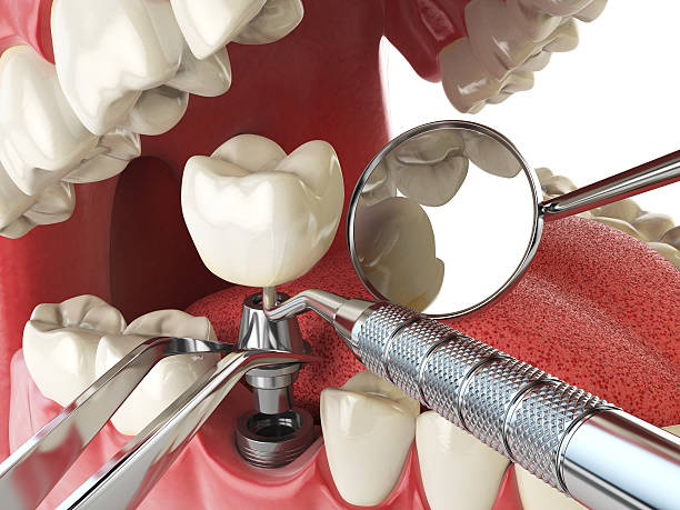 Best Emergency Dentist for Lost Fillings or Crowns in Mccamey, TX